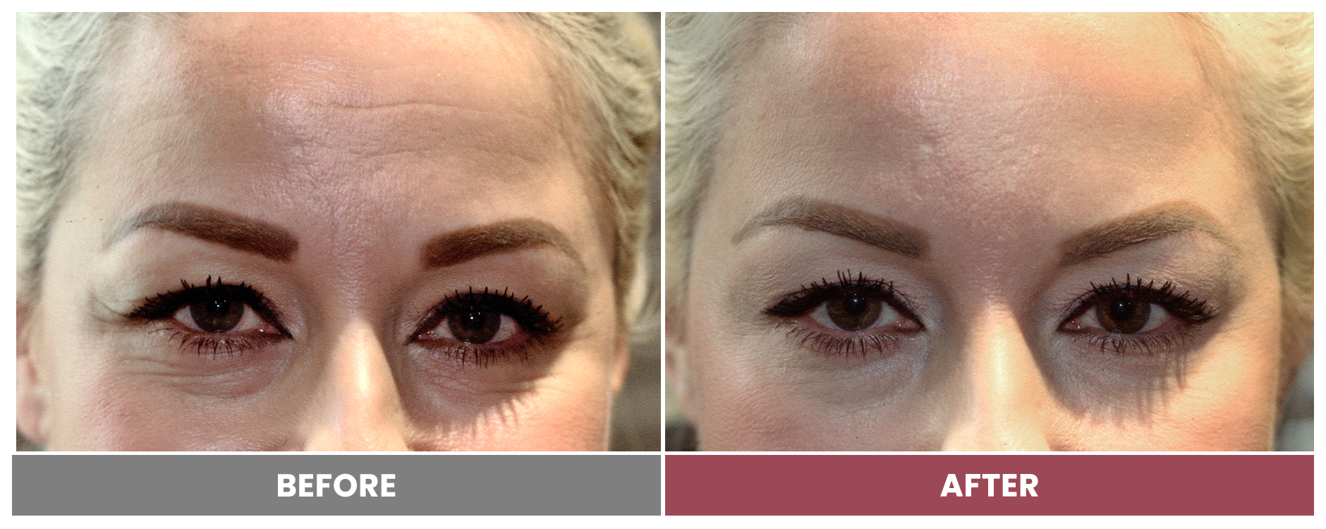 BOTOX FOR WRINKLES & BROW LIFT - Case 8